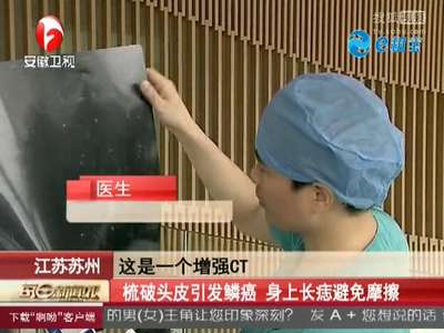 [视频]梳破头皮引发鳞癌 身上长痣避免摩擦