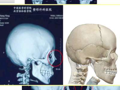 [视频]Baby面部鉴定爆假 台整形医生质疑：多出棒状物