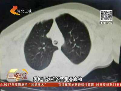 [视频]16个月宝宝差点被松子要命