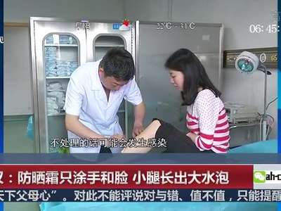 [视频]武汉：防晒霜只涂手和脸 小腿长出大水泡
