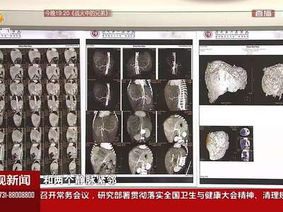 3岁患儿反复低烧暴瘦7斤 专家联手切除体内肿瘤